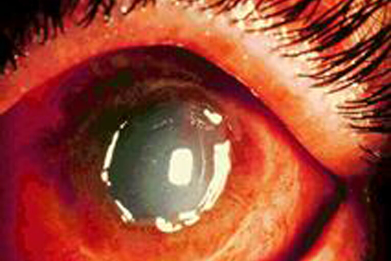 מסיר שומנים גרם לכוויה  כימית קשה בעין